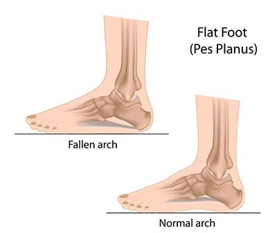 Newark Flat Feet