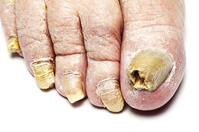 Newark Fungus Nails