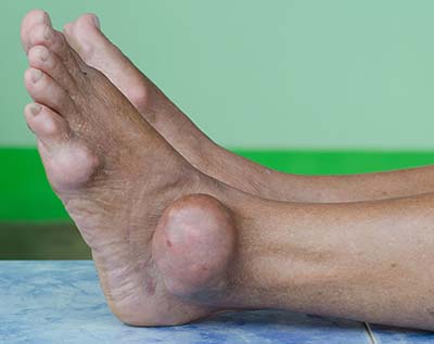 Gout Causes in Millburn