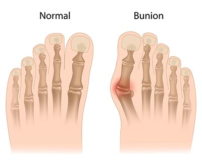 Newark Bunions