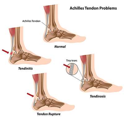 Achilles Tendonitis in Newark